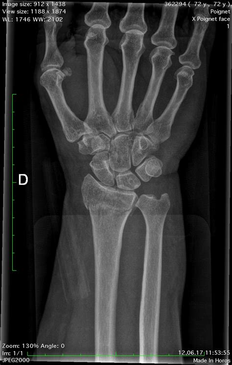 Wrist Fracture