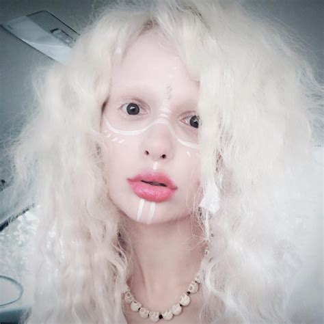 Albinism Nude