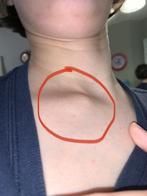 24f What Is This Lump On My Clavicle Raskdocs