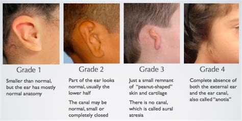 Microtia A Baby Born With Small Ears Medizzy Journal