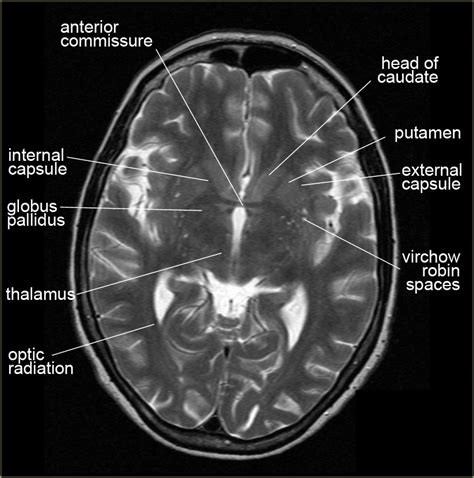 Ct Scan Brain Anatomy