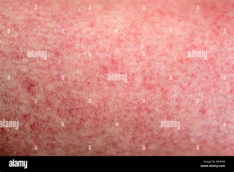 Piel Con Dengue Sarpullido Rojo Fotografía De Stock Alamy