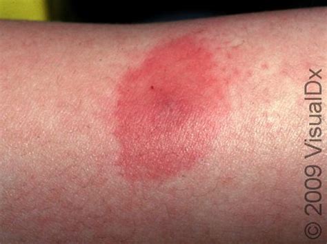 Bug Bites Or Stings Identification Treatment And Prevention