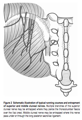 This is such a common subjective complaint in my practice as a manual therapist, and many patients insist it must be a muscle problem or jump to the conclusion. Accurate Education - Low Back Pain: Superior Cluneal Nerve ...