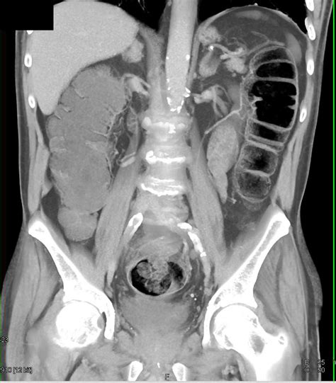 Benign Pneumatosis Of The Right Colon Colon Case Studies Ctisus Ct