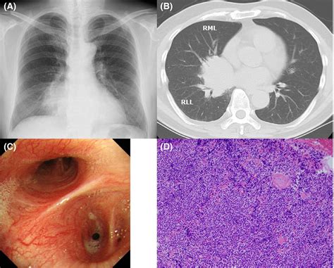 Pulmonary Mucosa‐associated Lymphoid Tissue Lymphoma Mimicking Lung