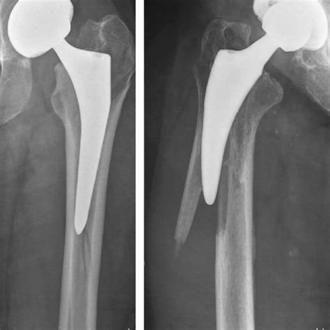 A Type B2 Periprosthetic Femoral Fracture Around Cemented Polished