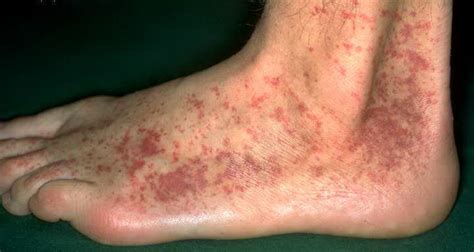 Allergic Vasculitisالتهاب الأوعية الأرجي