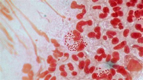 ‘highly Resistant Gonorrhea On The Rise In Canada Other Countries World Health Organization