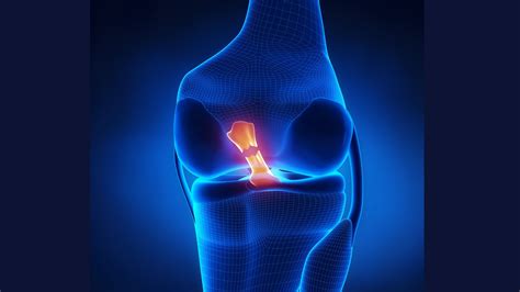 Symptoms Of A Torn Acl What To Do At Home Physiosunit