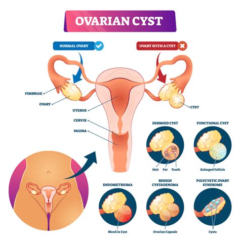 Ovarian Cysts What Are They What Are The Treatment Options