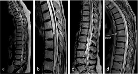 Magnetic Resonance Imaging Of The Spine Showing Arachnoiditis A Case