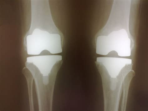 Joint Replacements Gallery Docjointsdr Sujit Jostotal Joint