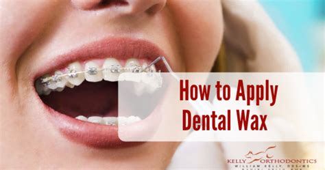 How To Use Wax On Your Braces Our 12 Best Tips For Your First Week With Braces Jk Orthodontics