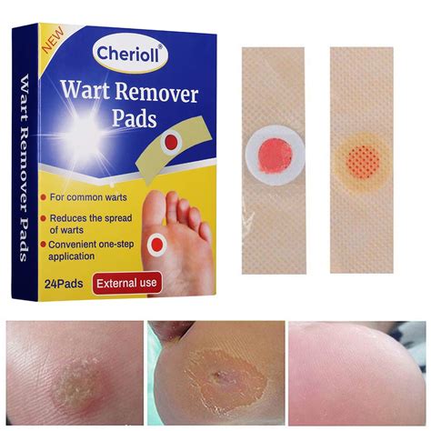 Buy Wart Remover Wart Removal Plasters Pad Foot Corn Removal Plaster