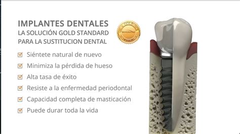 Implantes Dentales Biohorizons El Gold Standard Para El Reemplazo De Dientes Youtube