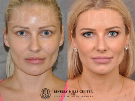 Laser Facelift Profound Microlift Before And Afters Beverly Hills