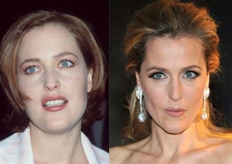 Gillian Anderson Plastic Surgery Before And After