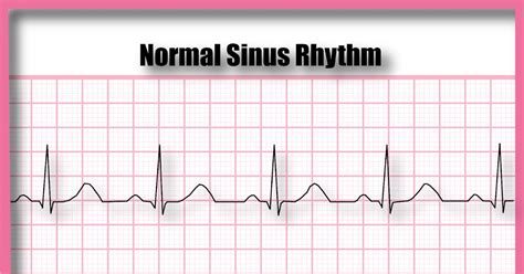 ECG Educator Blog Normal Sinus Rhythm