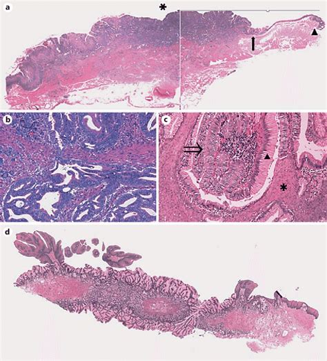 Histological Finding Of The Surgically Resected Specimen A Virtual