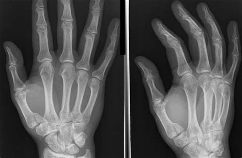 Base Of Thumb Fractures Hand Orthobullets