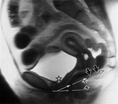 Practical Mr Imaging Of Female Pelvic Floor Weakness Radiographics