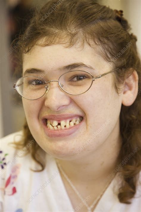 Portrait Of A Young Woman With Learning Disability Stock Image C047