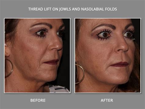 Mint Thread Lift Instant Non Surgical Facelift With Threads