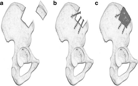 The Procedure Of Reconstruction Of The Iliac Crest After Autografting