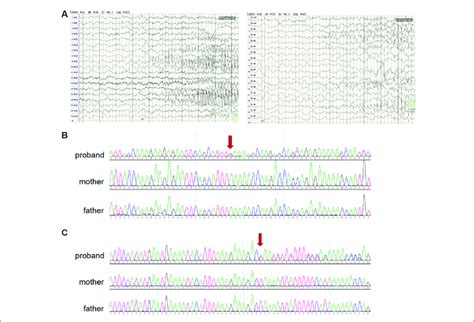 Clinical And Genetic Data A Electroencephalographic Eeg Of A