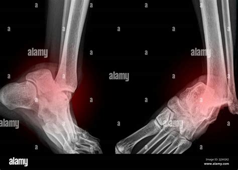 Dislocated Ankle X Ray Stock Photo Alamy