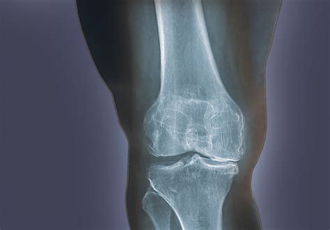 Asymptomatic Hyperuricemia Predictive Of Radiographic Knee Osteoarthritis Rheumatology Advisor