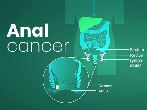 Anal Cancer Causes Symptoms Diagnosis And Treatment Boldsky Com