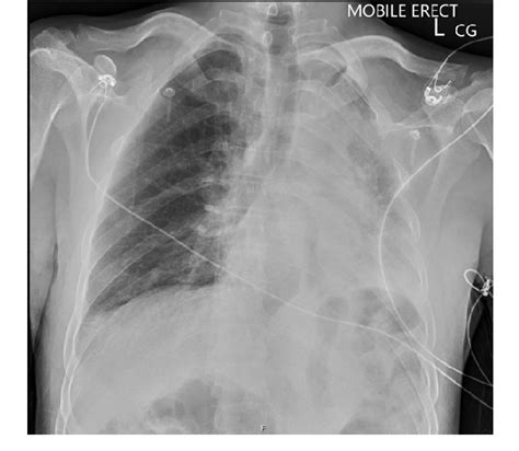 Figure 1 From Vascular Tracheobronchial Compression Syndrome Secondary