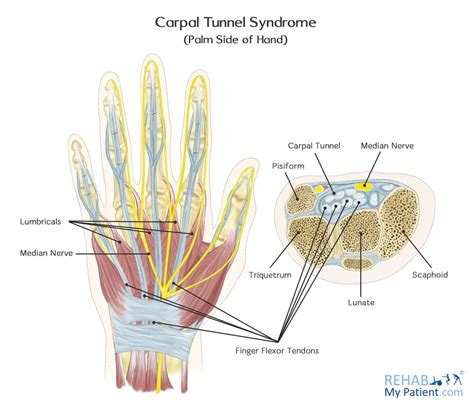 Classically, patients with the condition experience pain and paresthesias in the distribution of the median nerve, which includes. Carpal Tunnel Syndrome | Rehab My Patient