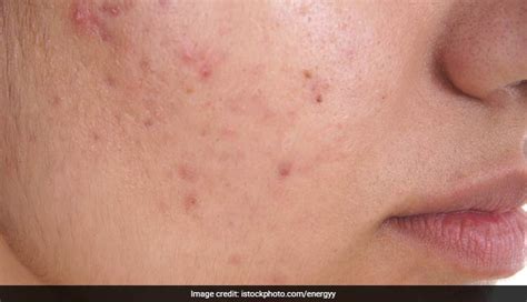 Get Rid Of Acne Blemishes With These 4 Easy Fixes