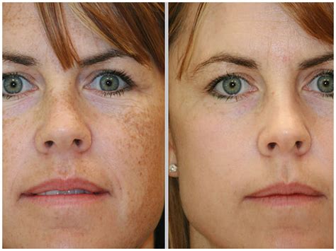 Bbl Photofacial Skin Rejuvenation At Pynch Anti Aging And Med Spa Services