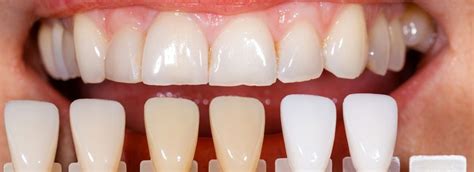 Porcelain Veneers Are Called Instant Orthodontics American Dental Clinic