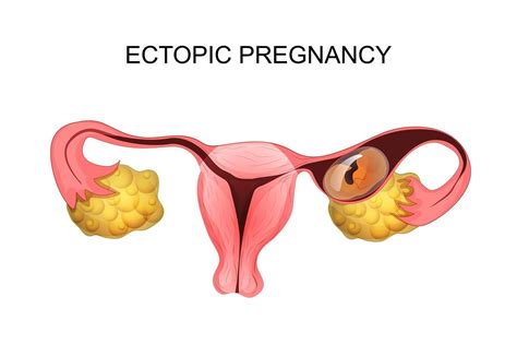 Ectopic Pregnancy Causes Symptoms Treatments
