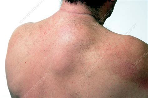 Large Lipoma On The Back Stock Image C0139723 Science Photo Library