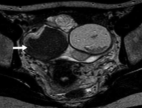 Imaging Findings Of Complications And Unusual Manifestations Of Ovarian