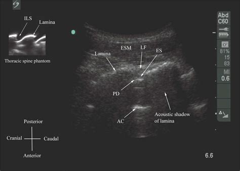 Spinal Sonography And Considerations For Ultrasound Guided Central