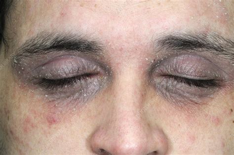 Eczema Around The Eyes Stock Image C0106665 Science Photo Library