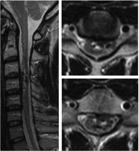Cervical Spine Magnetic Resonance Imaging A Sagittal T2 B And C