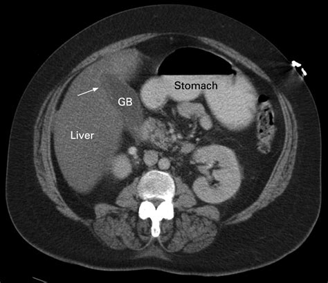Imaging After Medically Managed Severe Acute Cholecystitis Gut