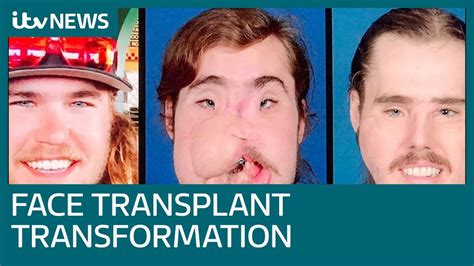 Face Transplant Patient So Grateful To Donor As He Reveals Incredible Transformation Itv