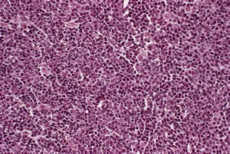 Lymphoma Cancer Stock Image M1320756 Science Photo Library