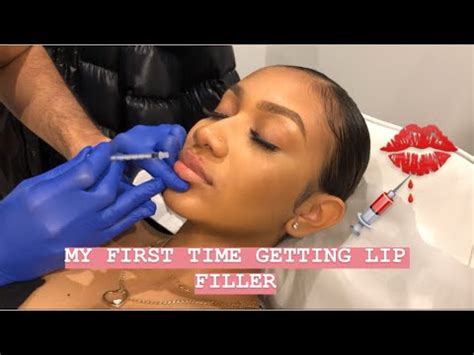 I GOT MY LIPS DONE MY LIP FILLER EXPERIENCE LIVE FOOTAGE