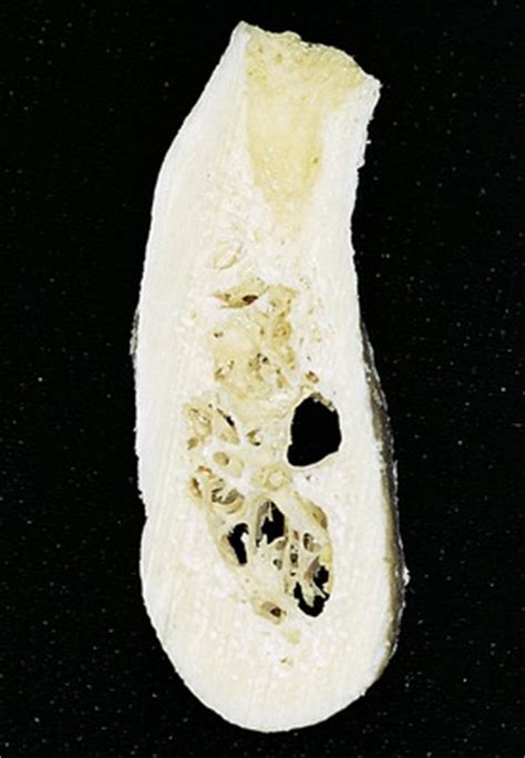 Compact bone cross section courtesy: 14: INFERIOR ALVEOLAR NERVE LATERALIZATION AND MENTAL ...