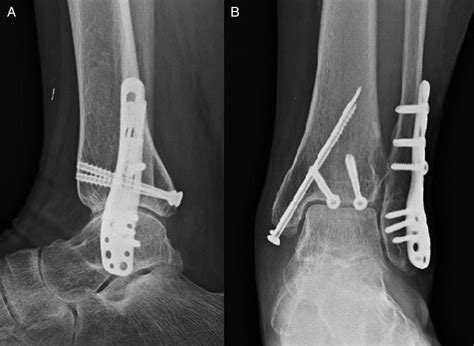 Single Oblique Posterolateral Approach For Open Reduction And Internal Fixation Of Posterior
